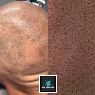 SMP to cover Alopecia patches and camouflage balding/thinning hair 

3 sessions of Scalp Micro Pigme