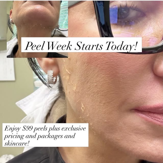 ✨ Peel Week starts today until Saturday! ✨

Peel off summer damage, melasma, acne scars and more wit