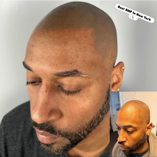 SMP correction NYC for a previous scalp micropigmentation treatment that was too dark, sharp, and un