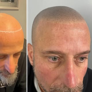 Scalp Micropigmentation New York | Natural SMP Results

Scalp micropigmentation New York clients cho
