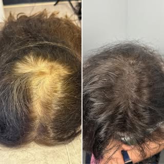 Women’s Density Fill SMP | Scalp Micropigmentation NYC

Scalp micropigmentation NYC treatments for w