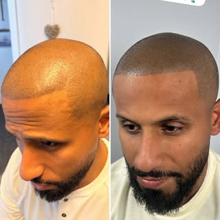 SMP Touch Up NYC | Scalp Micropigmentation Correction in New York

If your scalp micropigmentation h