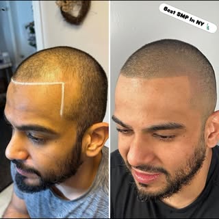 Density Fill SMP NYC | Scalp Micropigmentation for Thinning Hair in New York

Density fill scalp mic