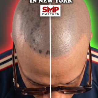 Botched SMP Repair NYC | Scalp Micropigmentation Correction in New York 🗽

Severe SMP correction pe