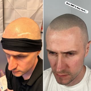 Scalp Micropigmentation NYC | Natural Hairline SMP New York

No harsh barber-line hairlines. No over