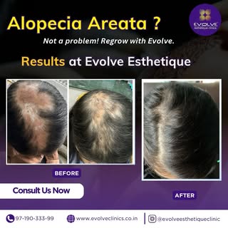 Alopecia? Not anymore! 💆‍♀️✨ Witness real hair regrowth & confidence like never before. #EvolveYour