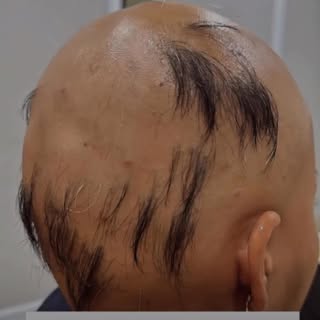 Alopecia? Not anymore! 💆‍♀️✨ Witness real hair regrowth & confidence like never before. #EvolveYour