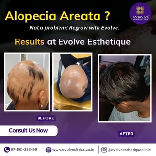 Alopecia? Not anymore! 💆‍♀️✨ Witness real hair regrowth & confidence like never before. #EvolveYour