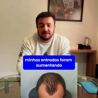 "Eu não queria mais tirar fotos. Hoje, minha autoestima mudou completamente."

A calvície vai muito 