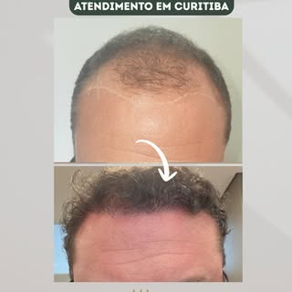 Resultados reais. Confiança renovada. 👏

Cada transplante capilar é planejado de forma individualiz