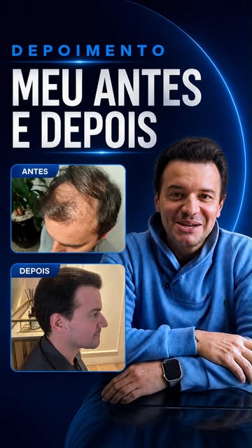 O medo da dor era o que mais preocupava esse paciente antes do transplante capilar.

Mas, com orient