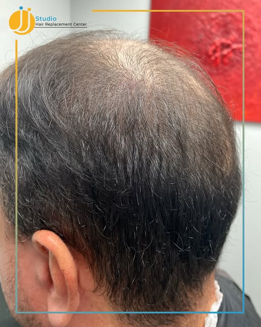Gánale a la pérdida de cabello con resultados reales y sin dolor. 💇🏽‍♂️✨ ¡Agenda tu cita! 📞 787.5