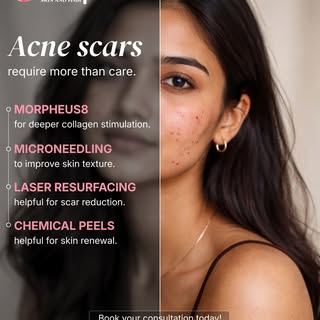 ✨ Acne scars need more than just basic care — they need expert solutions! ✨

At Kalp Skin & Hair Cli
