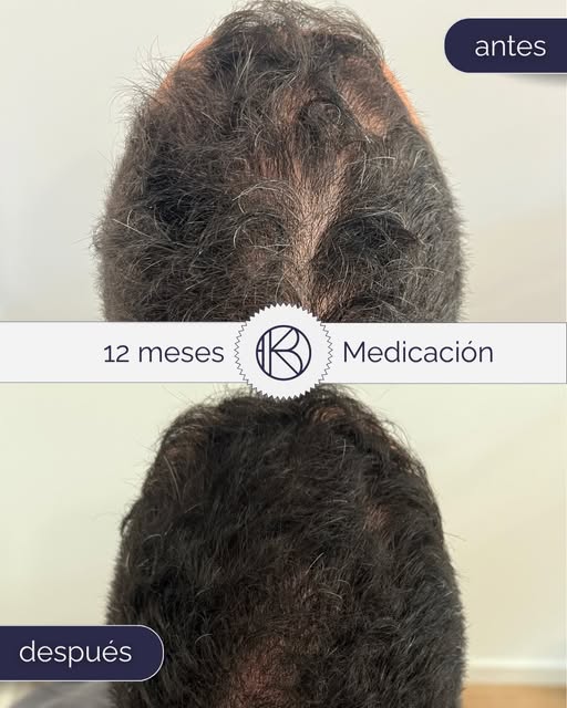¿Notas que la coronilla empieza a transparentar cuando te da la luz? Es algo muy común en la alopeci