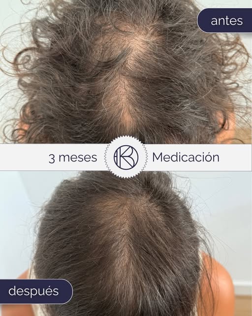Durante la premenopausia, los cambios hormonales afectan directamente al pelo, haciendo que se afine