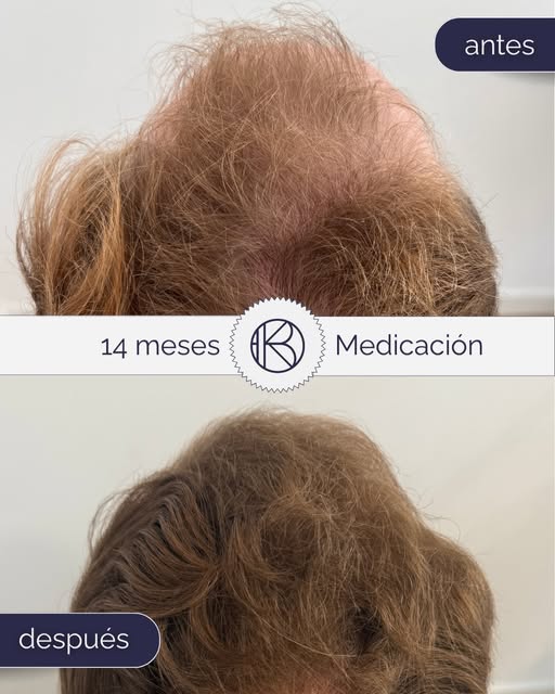 ¿Te pasa que al peinarte notas que el pelo ha ido perdiendo grosor? 🤔

Cuando la alopecia está en f