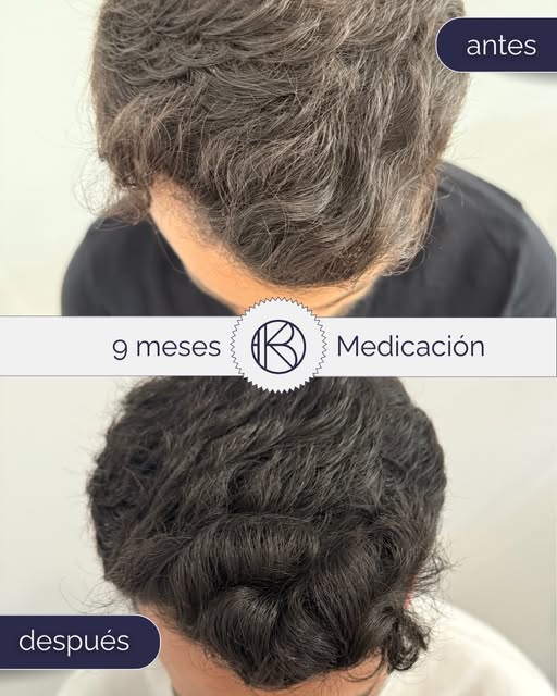 ¿Te preocupa ver que la coronilla va perdiendo densidad con el paso de los meses? 😞

La constancia 