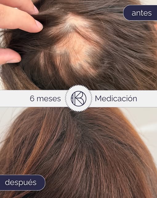 💊 Combinando medicación oral, tópica y microinyectada, reactivamos el folículo por completo en este