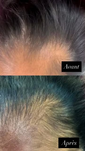 Résultat après la première séance de micro pigmentation du cuir chevelu pour cette cliente atteinte 