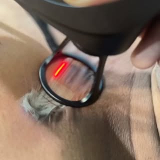 Are you struggling with a stubborn keloid that’s affecting your confidence?Here's the solution-CO2La