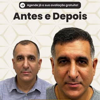 Vejam essa evolução de 6 meses de transplante capilar.

📲Link na bio e saiba mais!

#transplantecap