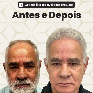 Vejam essa evolução de transplante capilar. 

📲Link na bio e saiba mais!

#transplantecapilar #hair