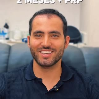 2 meses de acompanhamento pós-transplante capilar 🚀

O acompanhamento após o transplante é uma etap