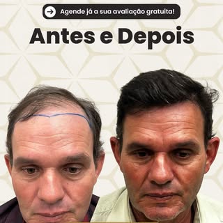 Vejam essa evolução de transplante capilar. 

📲Link na bio e saiba mais!

#transplantecapilar #calv