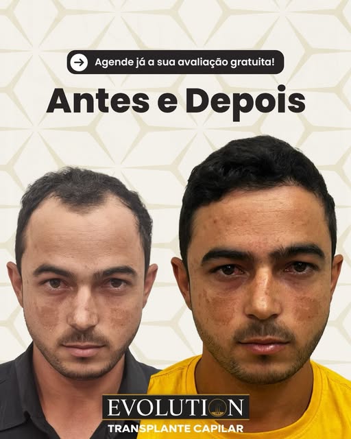 Vejam essa evolução de transplante capilar. 

📲Link na bio e saiba mais!

#transplantecapilar #hair