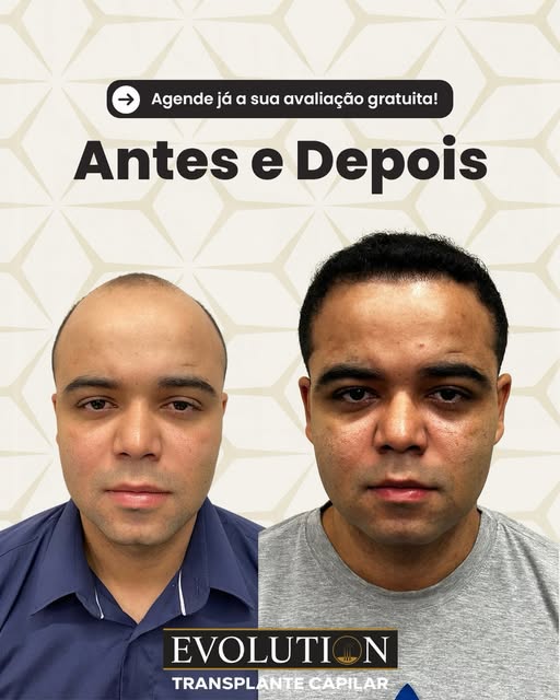Vejam essa evolução de transplante capilar. 

📲Link na bio e saiba mais!

#transplantecapilar #hair