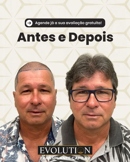 Vejam essa evolução de transplante capilar. 

📲Link na bio e saiba mais!

#transplantecapilar #calv