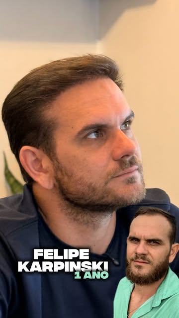 Quando o Felipe chegou até nós, a calvície já afetava sua autoestima há bastante tempo. Ele havia pe