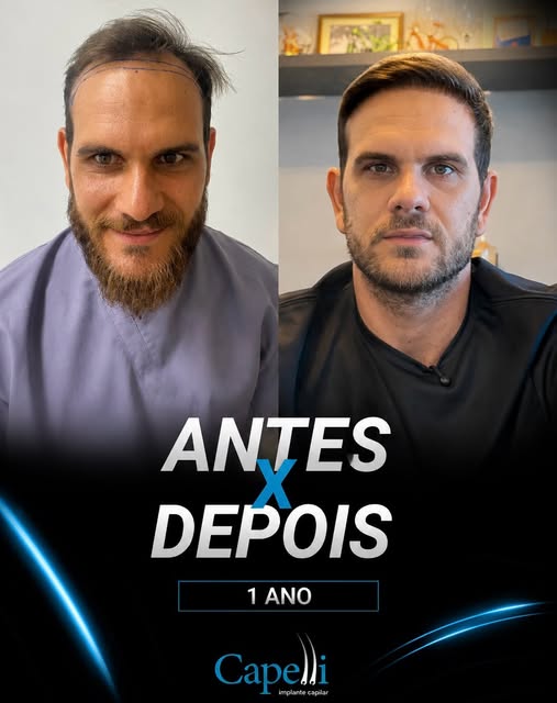 Mais um caso real por aqui! 🙌

Nosso paciente Felipe Karpinski completou 1 ano do transplante capil