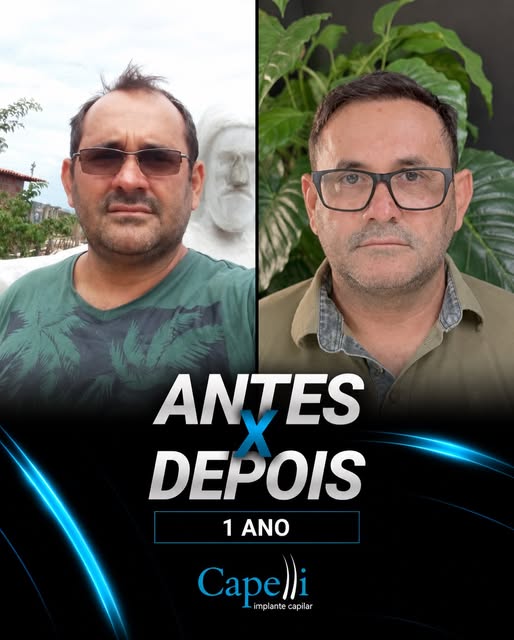 Um novo visual, preservando o que mais importa: a naturalidade.

Neste caso, o transplante capilar f