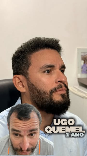 Esse é o Ugo Quemel, e acompanhar a evolução dele foi muito bacana.

Antes do transplante, as entrad