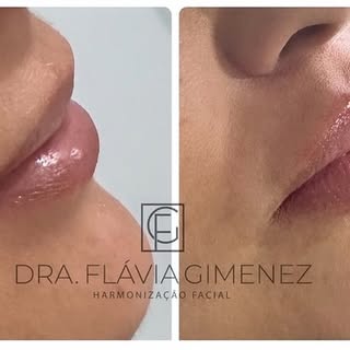 ✨Preenchimento Labial: natural, hidratado e do seu jeito ✨

Lábios mais definidos, com contorno harm
