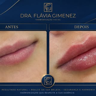 Preenchimento Labial
Harmonia que valoriza sua essência

Naturalidade em cada detalhe ✨