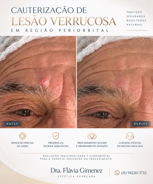 ✨ CAUTERIZAÇÃO DE LESÃO VERRUCOSA

Tratamento realizado em região periorbital, com remoção precisa d
