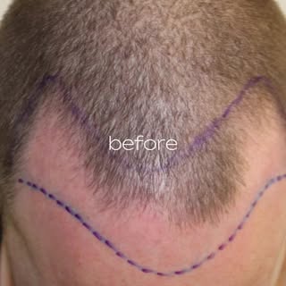 GOOD FEELINGS 🥰

 #Haartransplantatie #haarlijn #inhammen #naturallook #Omorfy #mooihaar