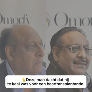 Veel mensen denken dat ze te kaal zijn voor een haartransplantantie. In sommige gevallen is er inder