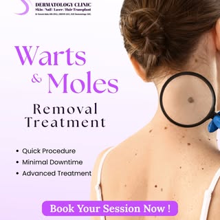 Warts & Moles Removal Treatment in Adambakkam | Best Dermatologist in Chennai

Have a wart or mole t