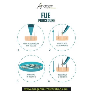 FUE is a highly advanced and intricate, surgical procedure to restore hair loss. What are the facts,