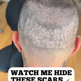 These FUE hair transplant scars didn’t stand a chance 💪🪄

Awesome working with my guy @jcrosary 🇵