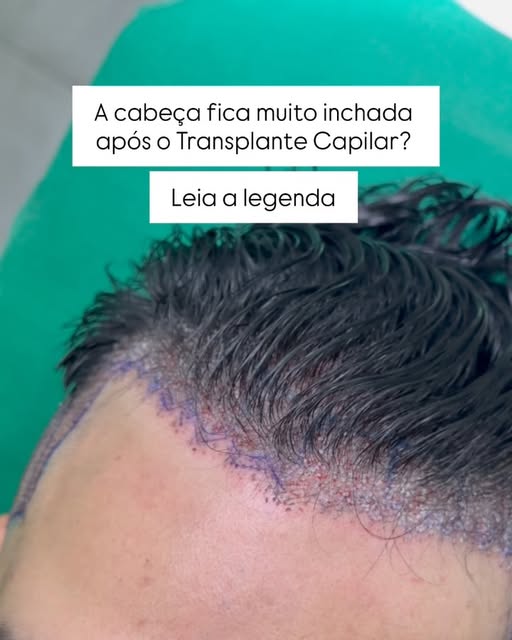 🇧🇷 A maioria dos casos em que a cabeça e o rosto ficam muito inchados é devido à grande quantidade