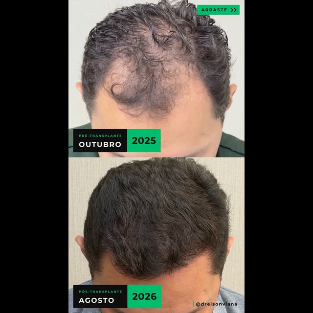 🇧🇷 Antes e depois de transplante capilar com restauração da região frontal: excelente resultado, c