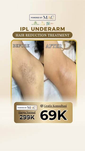 💜 IPL UNDERARM CUMA 69K!

Ketiak gelap bikin kamu kurang percaya diri pakai outfit favorit? 👀
Saat