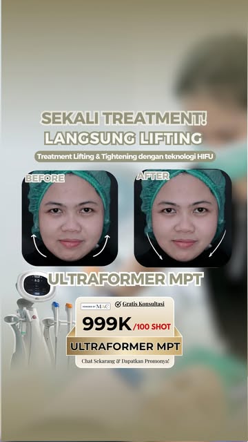 ✨ Kenalan dengan Ultraformer MPT! ✨
Ingin kulit terasa lebih kencang dan contour wajah terlihat lebi