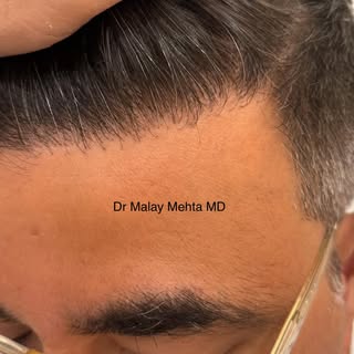 4th one is my fav, let me know your fav in in comments!

‘Hairline design is everything in hair rest