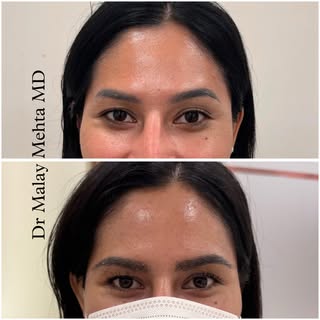 Natural brows. Lasting confidence. ✨

This 30-year-old patient underwent an eyebrow enhancement proc