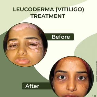 🌟 Regain your confidence with advanced Leucoderma (Vitiligo) treatment at Charutar Hospital. Our ex